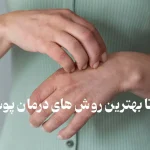 روش درمان پوست مرغی