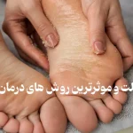 علت ترک پا